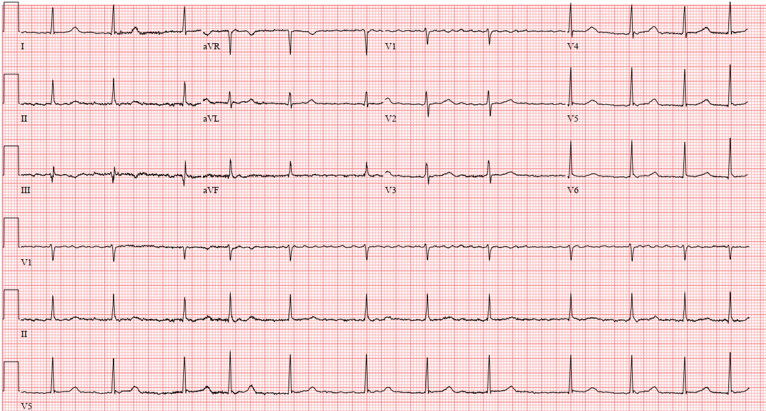 Atrial Fibrillation (AF) — When the Beat Drops: A Resident's Guide to ...