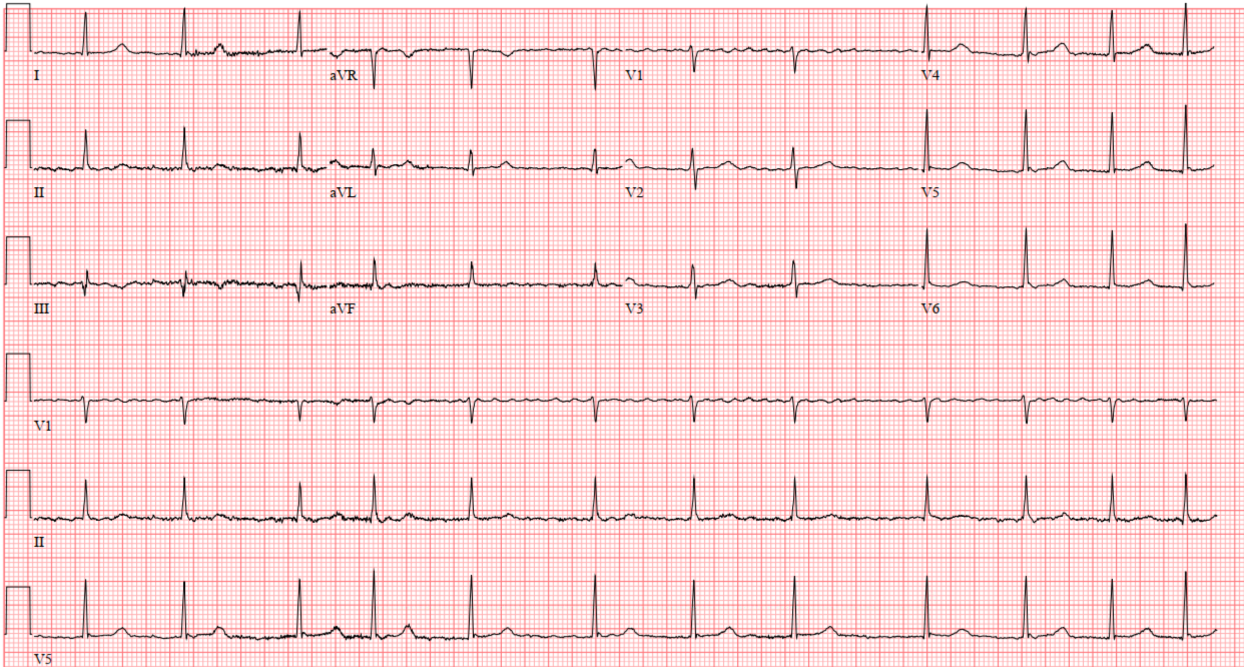 Atrial Fibrillation (AF) — When the Beat Drops: A Resident's Guide to ...