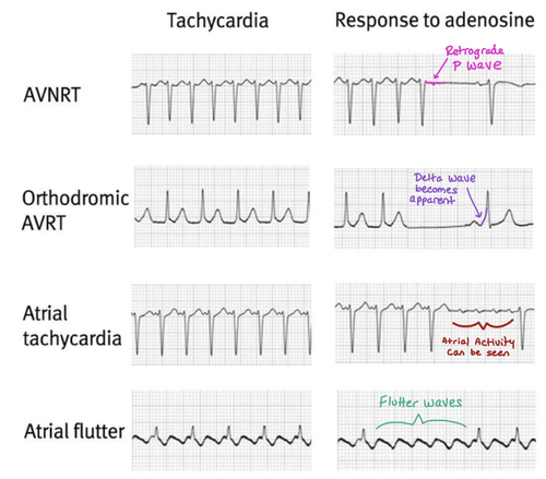 SVT: AVRT vs AVRNT — When the Beat Drops: A Resident's Guide to the CCU