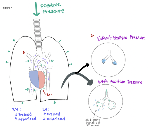 Non-Invasive Positive Pressure Ventilation — When the Beat Drops: A ...