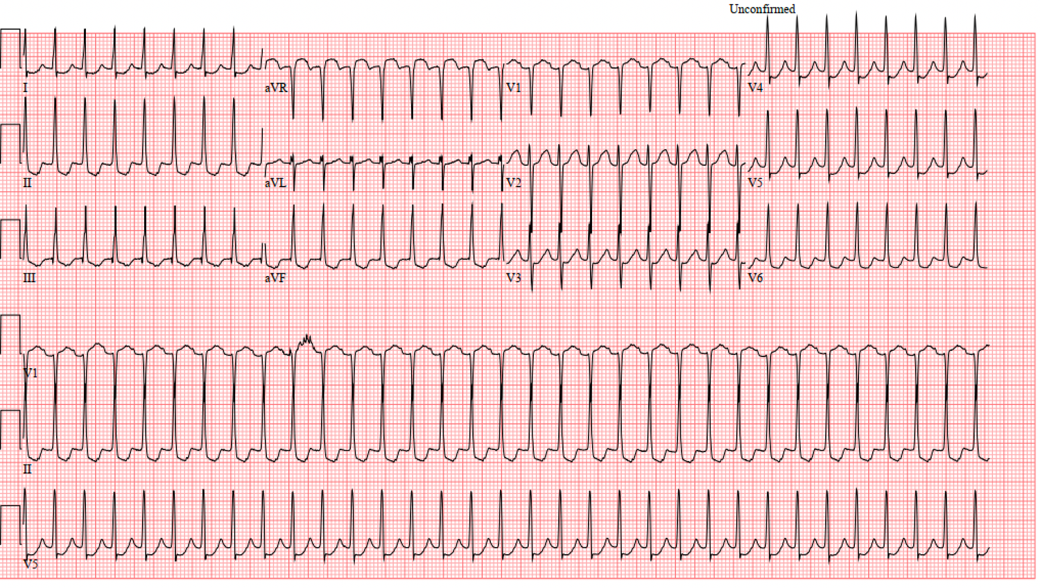 SVT: AVRT vs AVRNT — When the Beat Drops: A Resident's Guide to the CCU