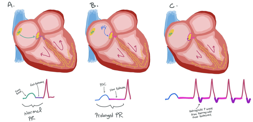 SVT: AVRT vs AVRNT — When the Beat Drops: A Resident's Guide to the CCU