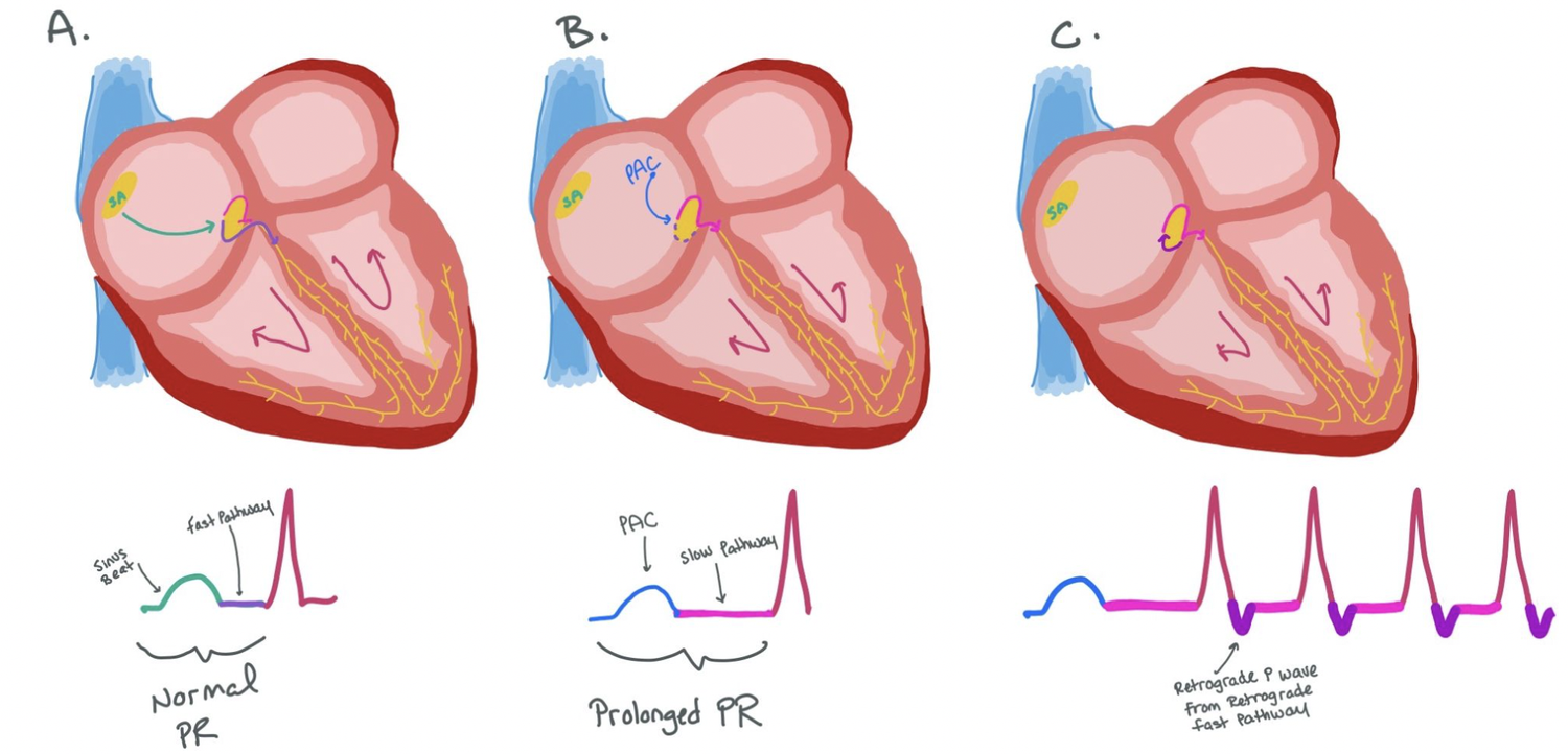 SVT: AVRT vs AVRNT — When the Beat Drops: A Resident's Guide to the CCU