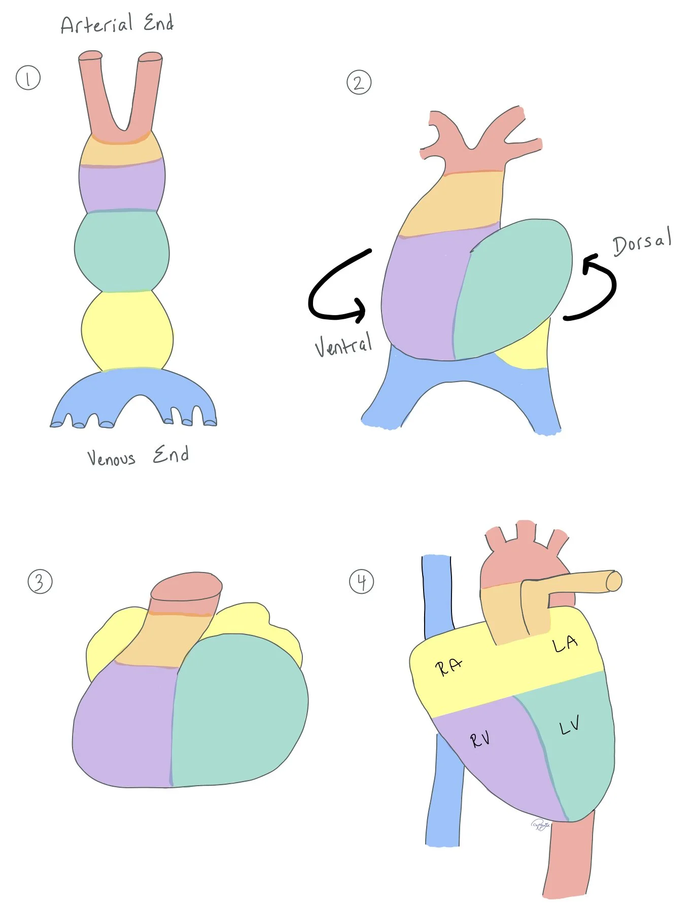 Tetralogy of Fallot — When the Beat Drops: A Resident's Guide to the CCU