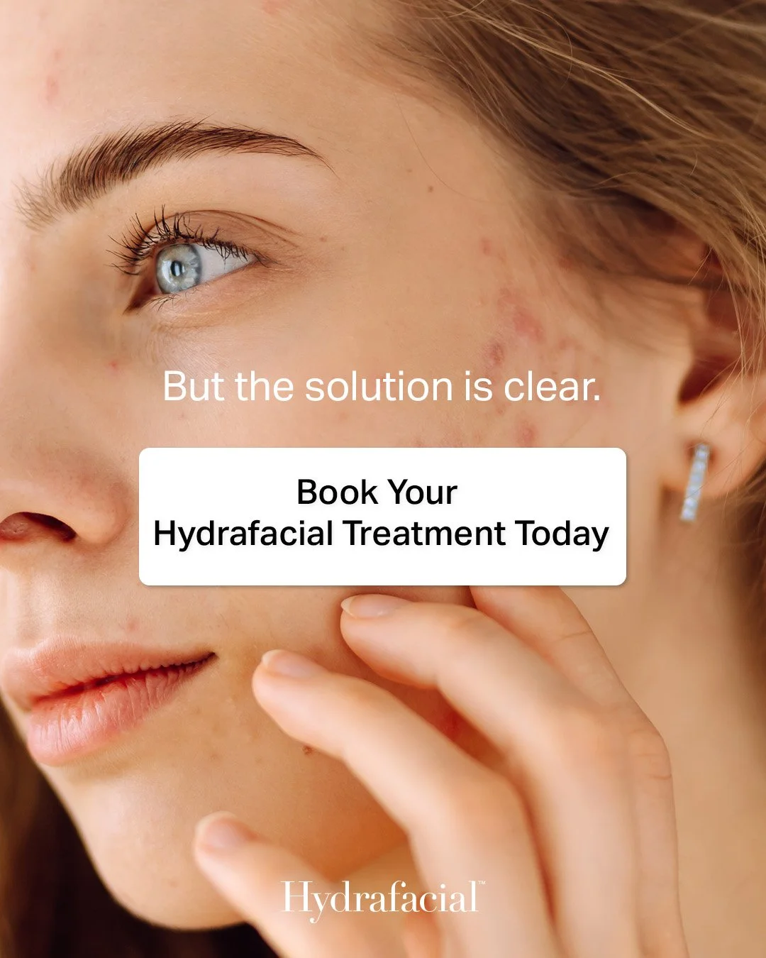 Hydrafacial acne