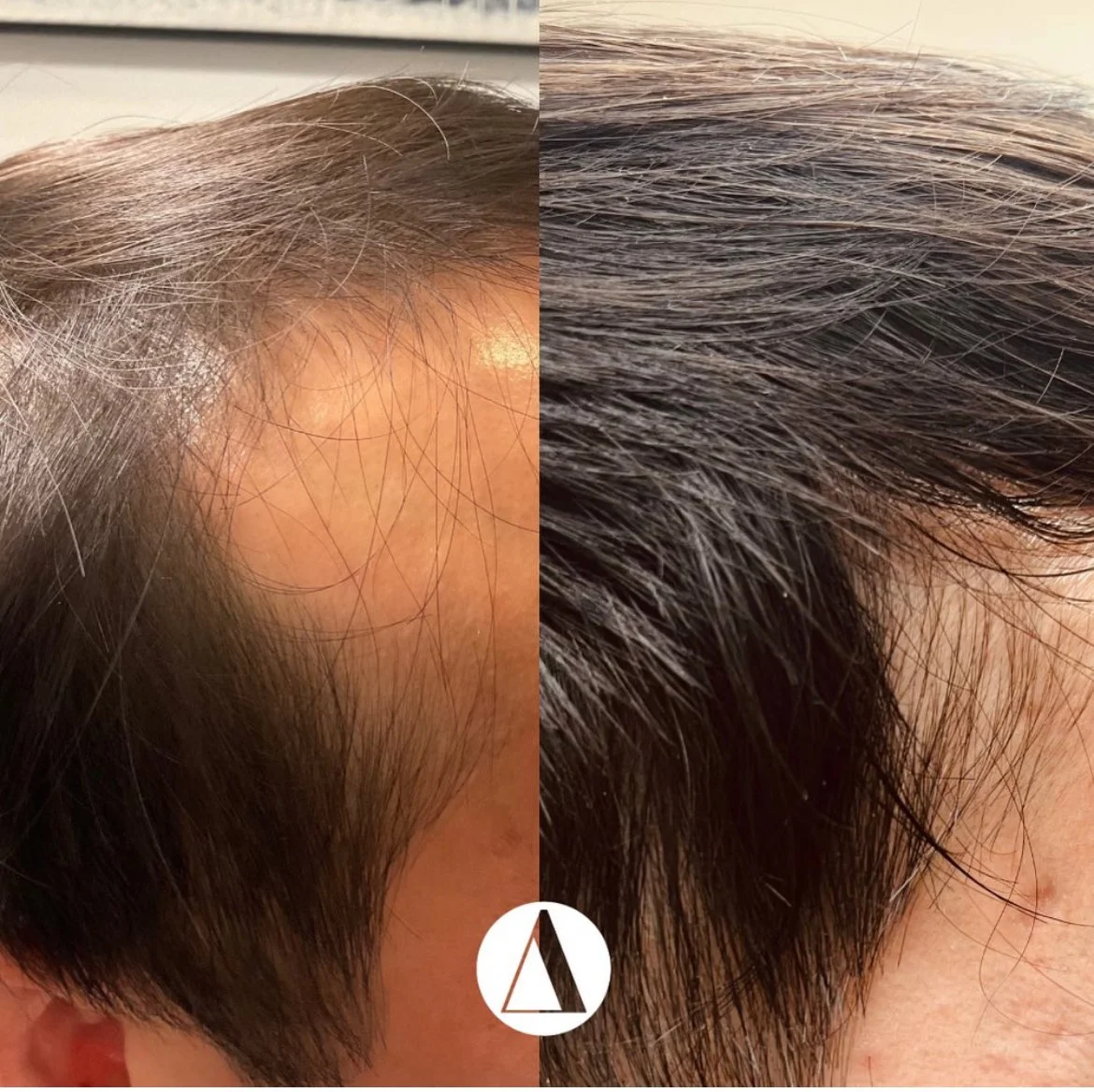 PRP Hair Restoration
