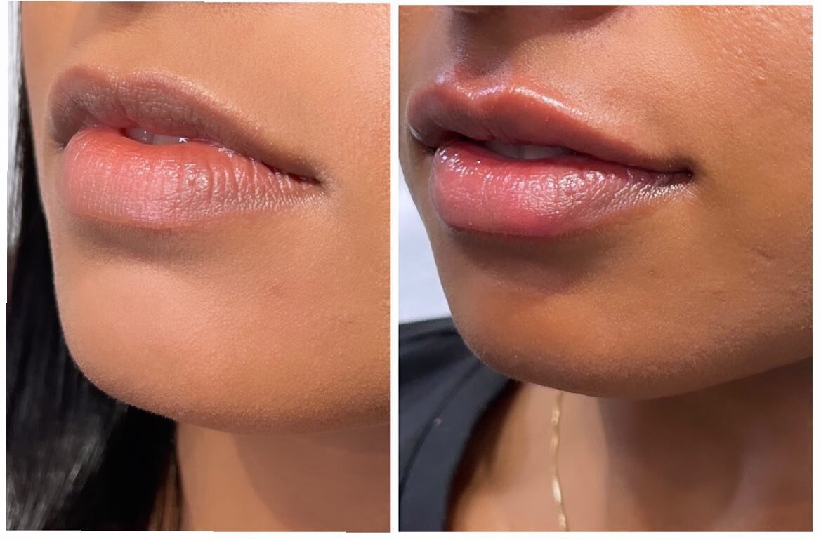 💋 Hydration and symmetry at its Finest! Experience the transformative power of a mini lip dermal filler hydration! 💋⁣⁣

✨ Benefits of Mini Lip Dermal Filler Hydration ✨:
💉Instant Hydration: Achieve soft, supple lips with our specialized dermal fil