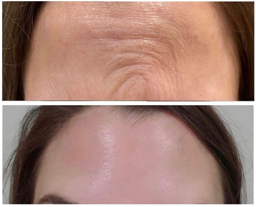 Prevention is key! Anti-wrinkle injections administered by Nurse Nick to this client&rsquo;s forehead muscles reduced fine lines caused by repetitive movement. 

By targeting overactive muscles, we restore a youthful, relaxed appearance with results 