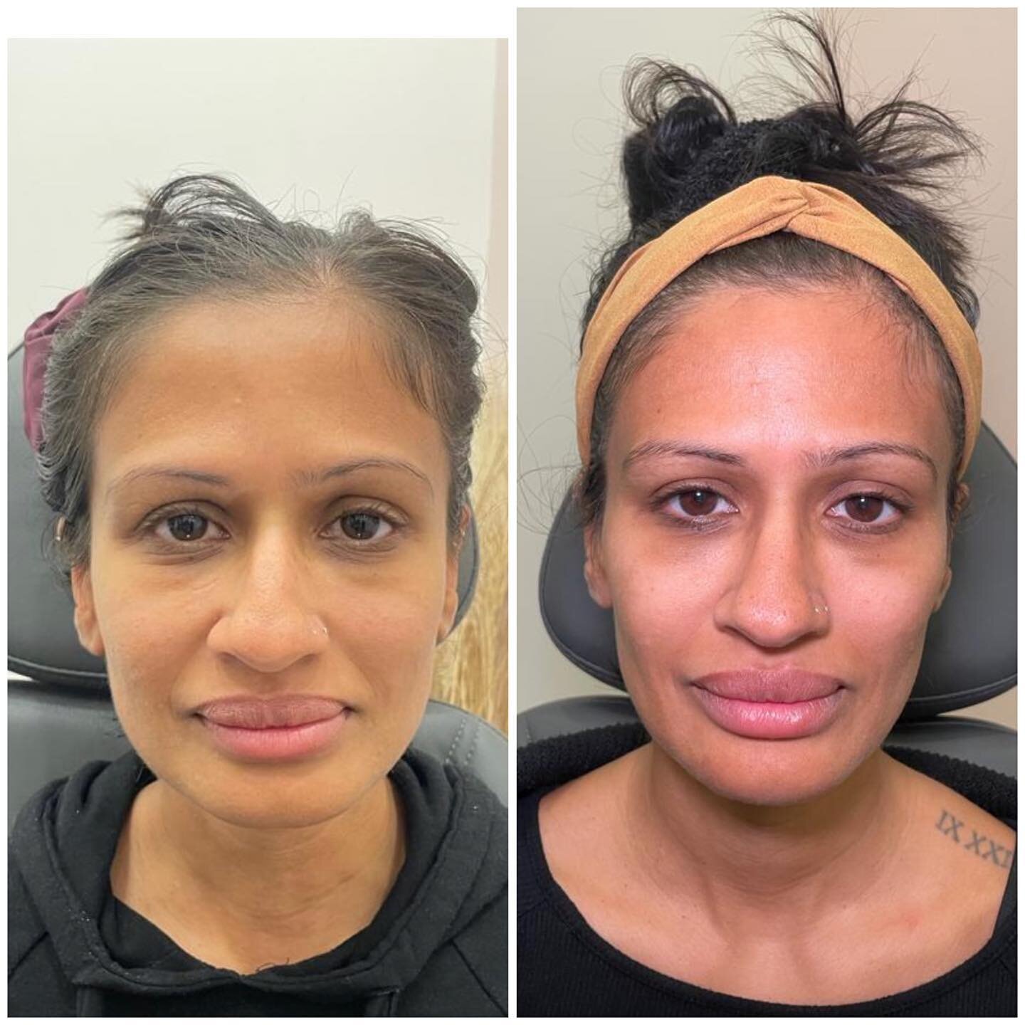 This happy client regained a youthful glow with undetectable dermal fillers in her cheeks, chin and a mini filler hydration for her lips. Best part is that fillers can help you achieve symmetrical contours naturally when done by skilled professionals