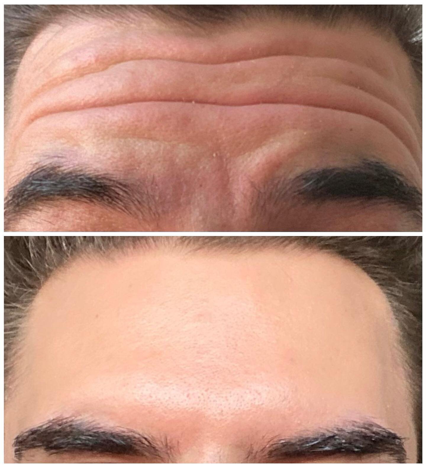 Say goodbye to unwanted wrinkles with neuromodulators! Our happy customer is delighted with his results. Embrace a smoother complexion today! 
.
.
.
.
.
#wrinklereduction #wrinkleprevention #youthfulglow #neuromodulators #xeomin #medicalaesthetics #A