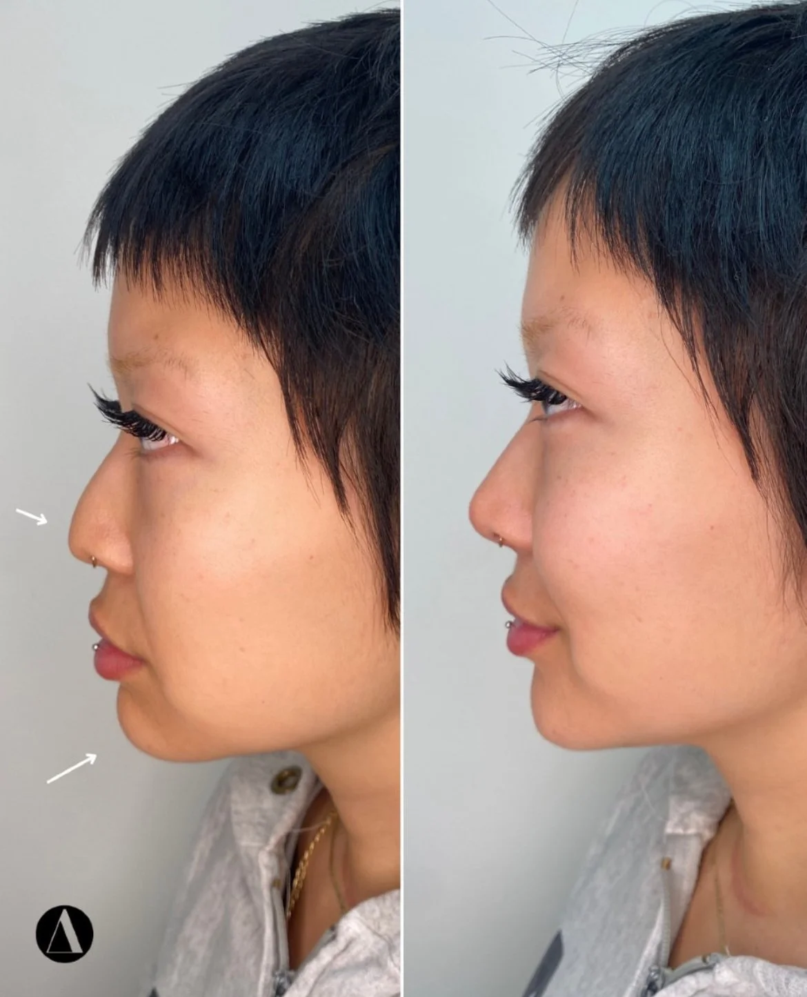 Chin Filler and Liquid Nose Job