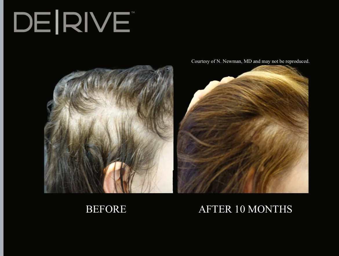 DE│RIVE BEFORE and AFTER HAIR LOSS GROWTH