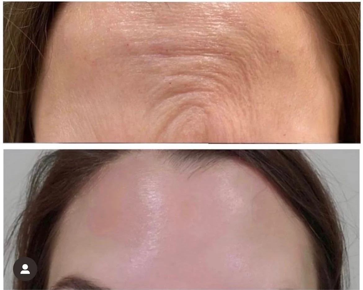 Forehead Wrinkle Botox