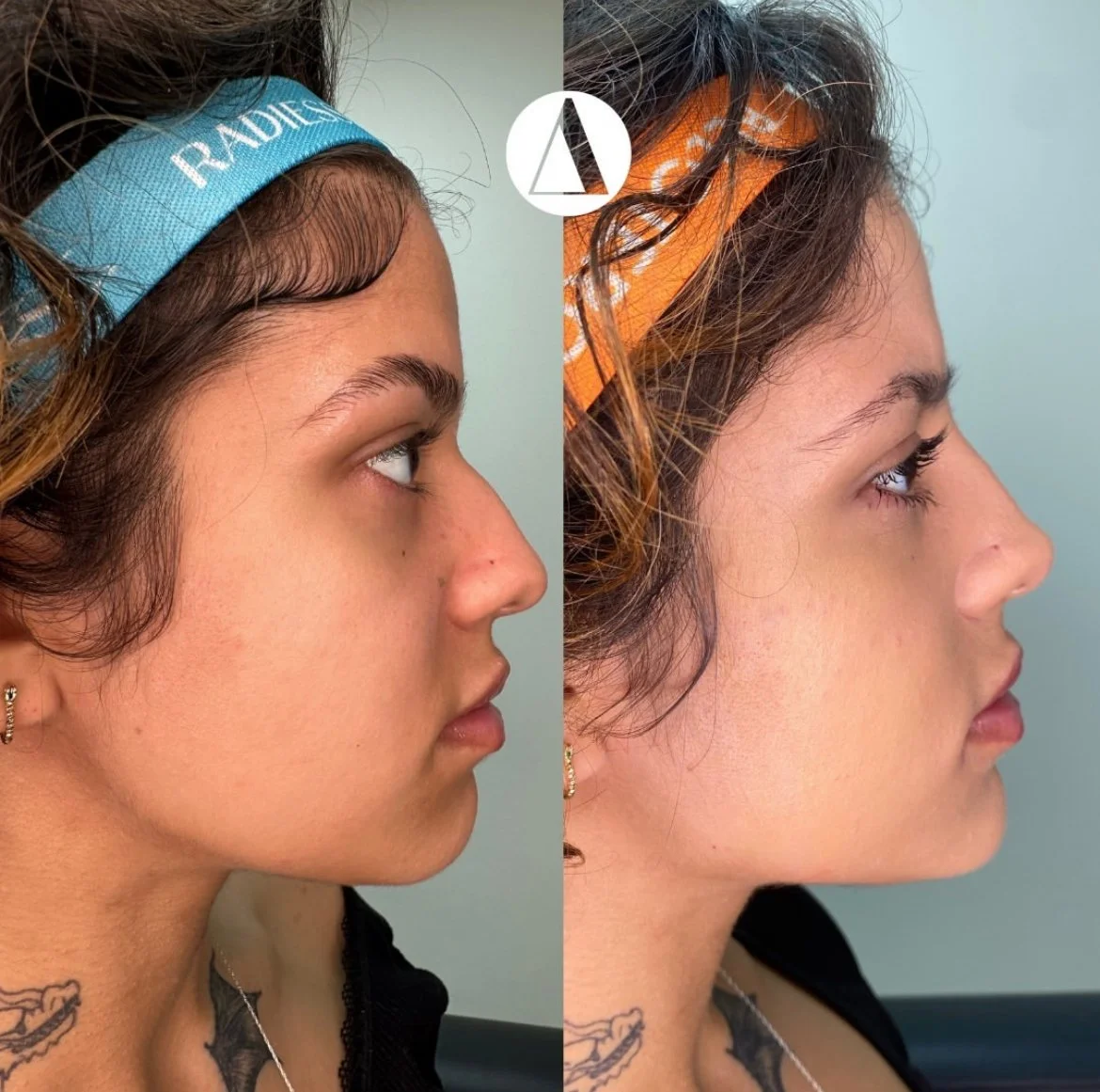 Full Face Balancing with Filler