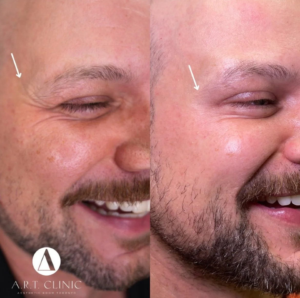 Crow's Feet Botox