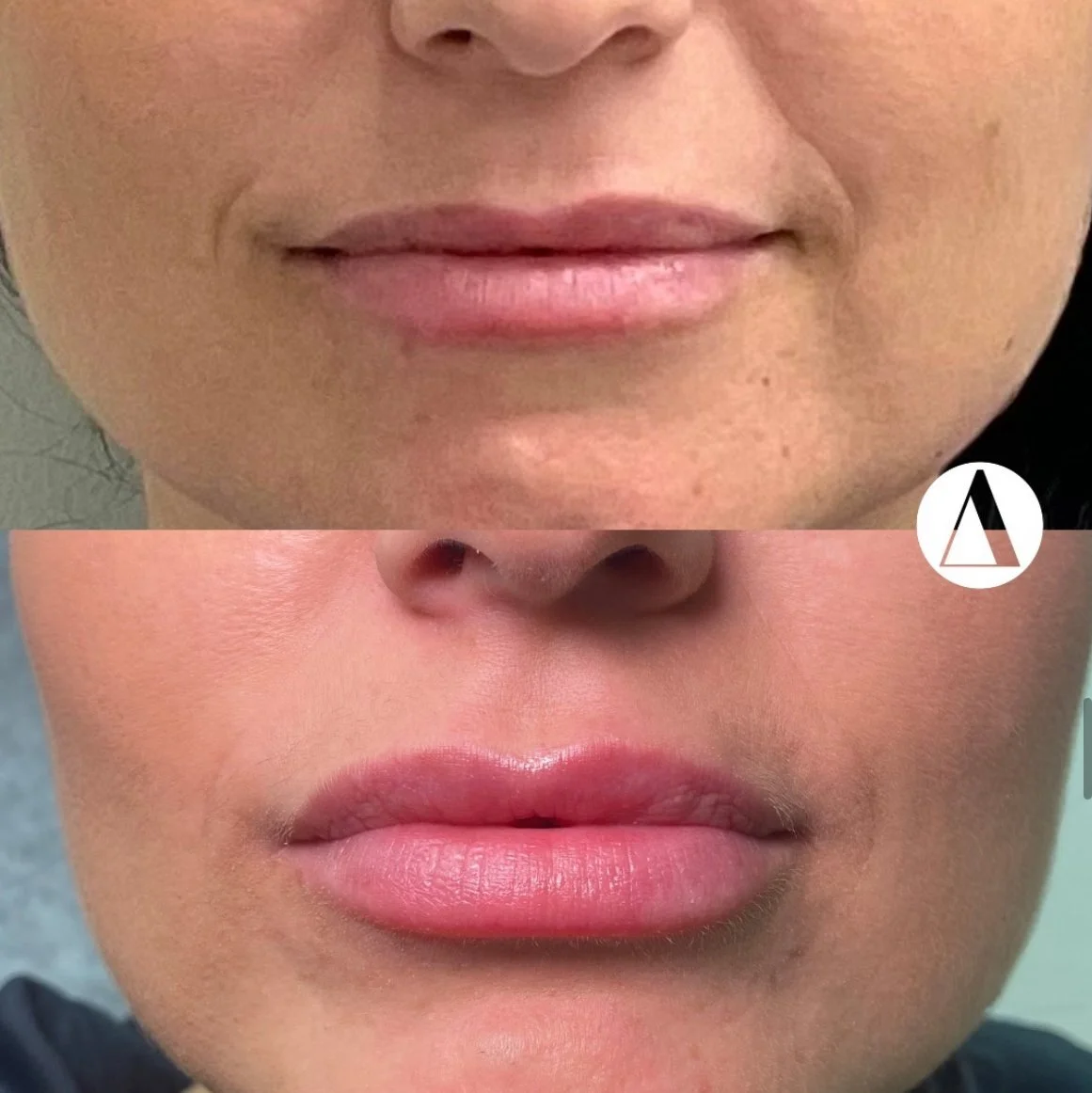 Lip filler full syringe before after