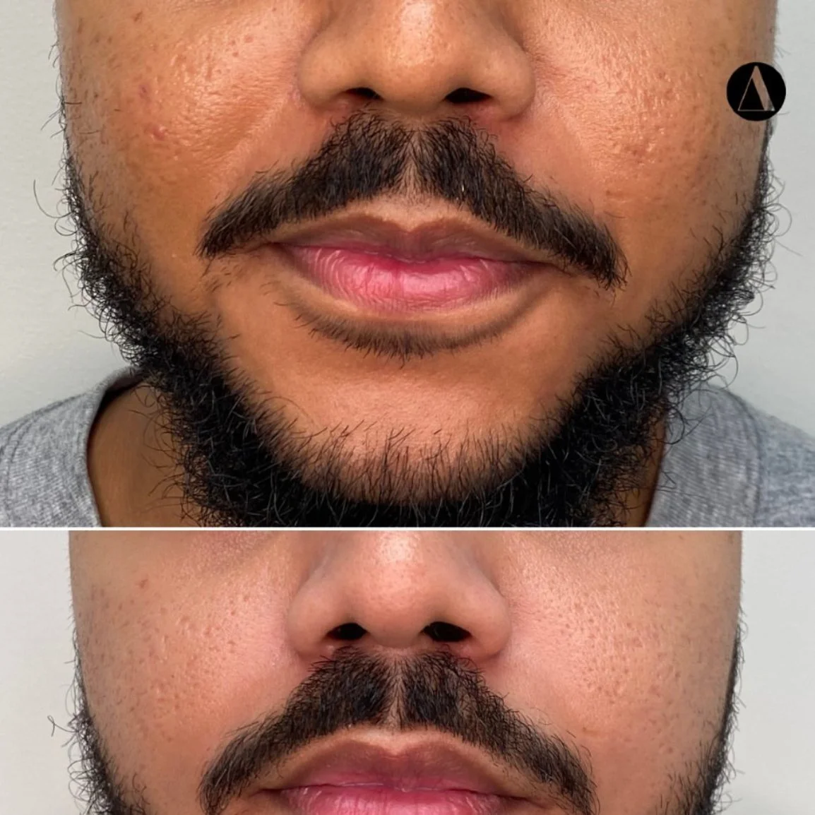 Microneedling Acne and Acne Scars Before/After Skin tone texture results Dermapen4 PD4