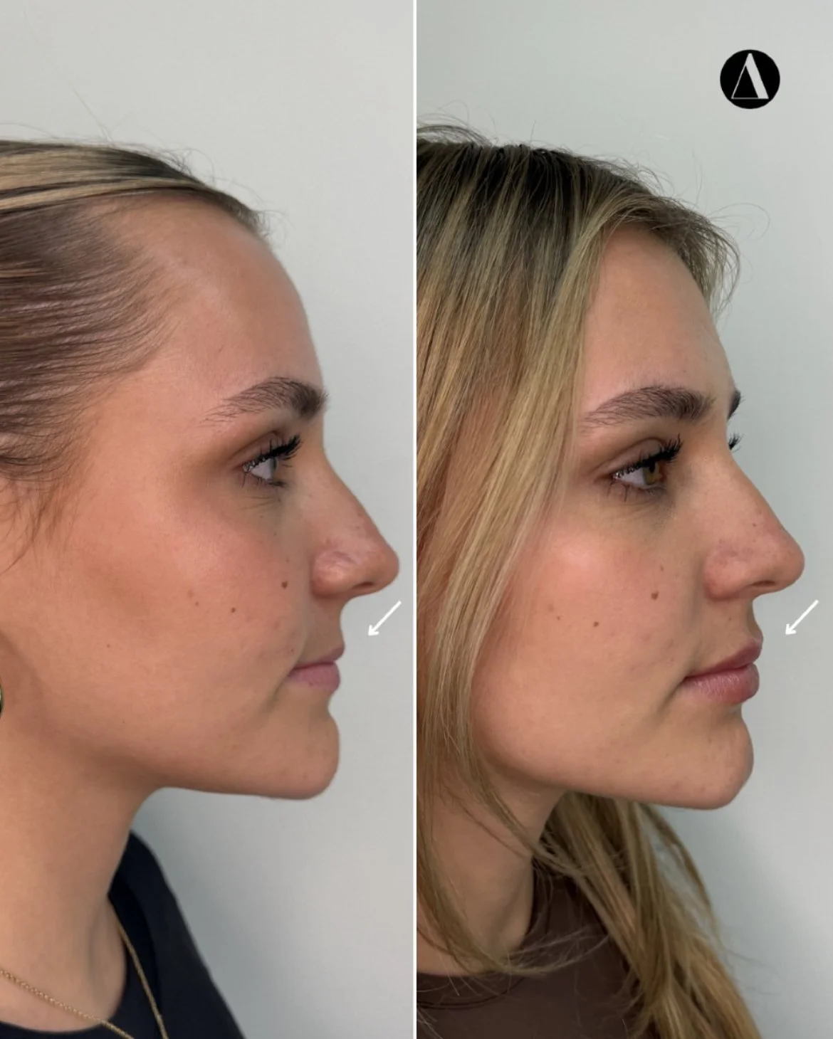 Subtle lip filler and lip hydration treatment