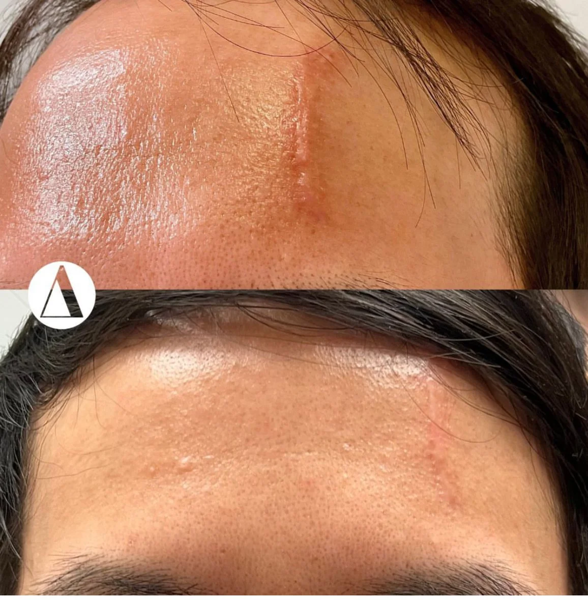 Scar Revision