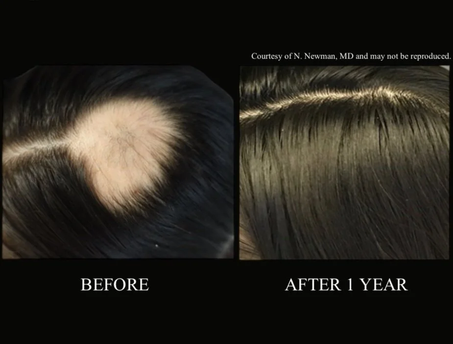 DE│RIVE BEFORE and AFTER HAIR LOSS GROWTH