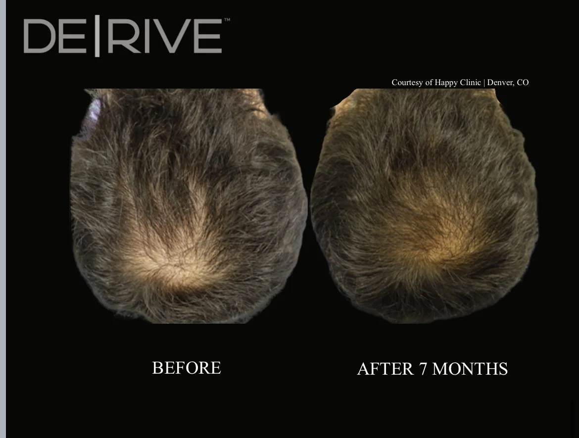 DE│RIVE BEFORE and AFTER HAIR LOSS GROWTH