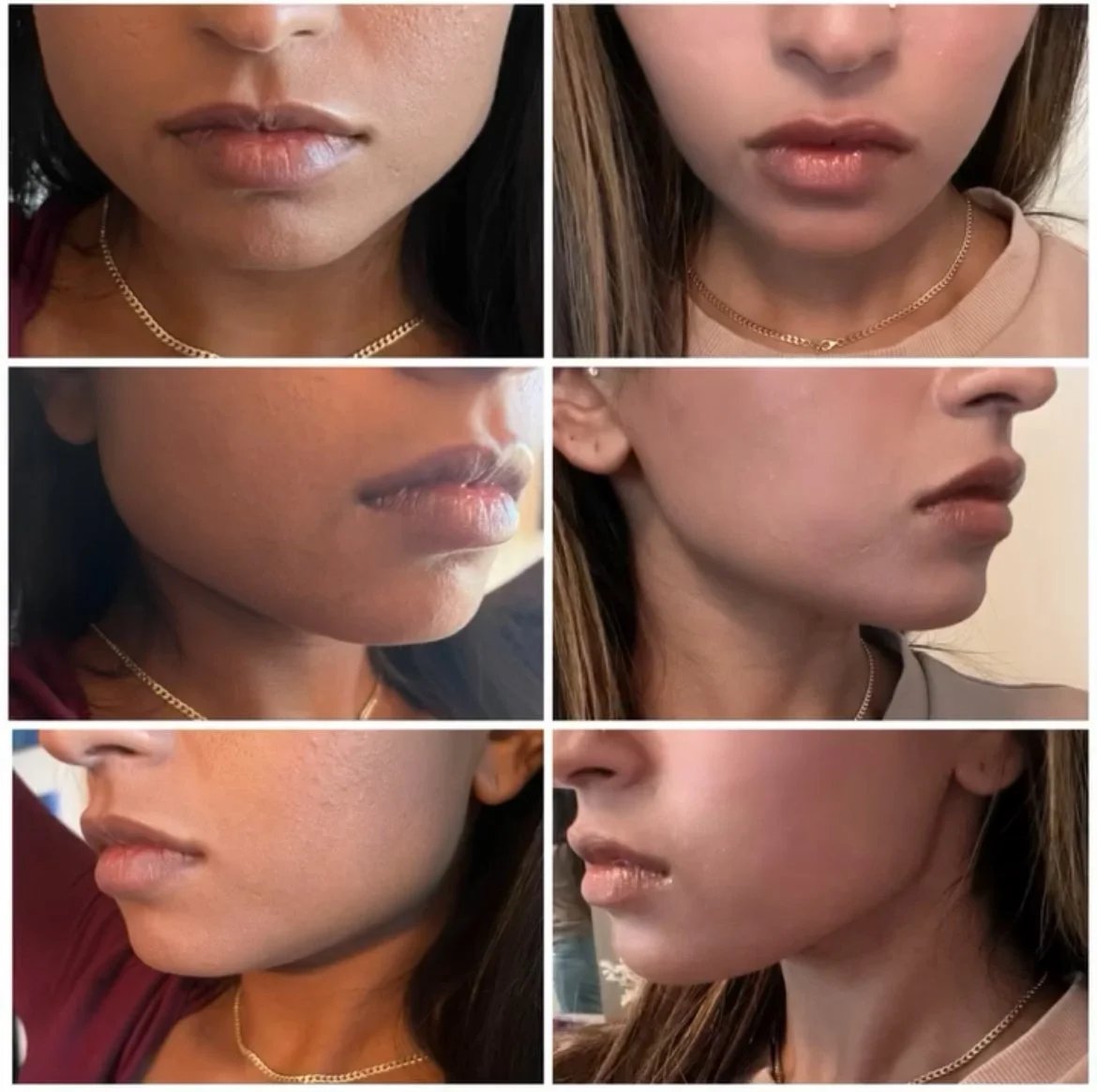 Masseter Jawline Slimming Botox