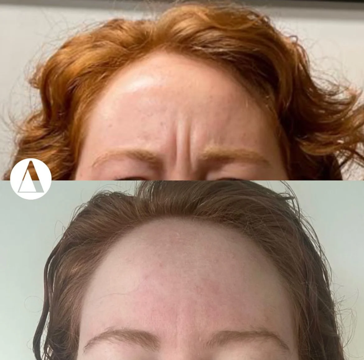 Frown Line Botox