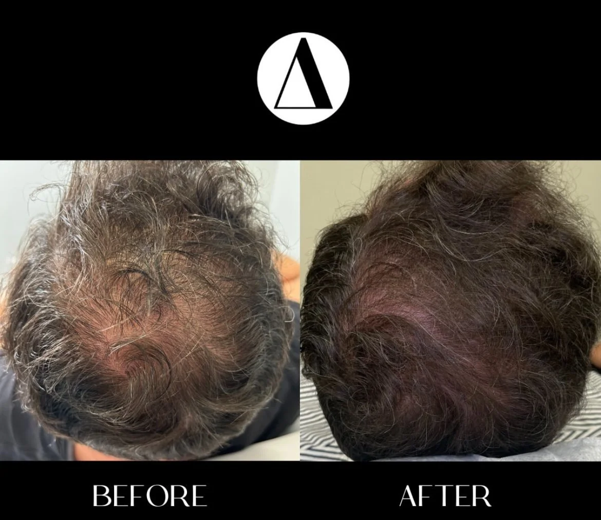 PRP Hair Restoration