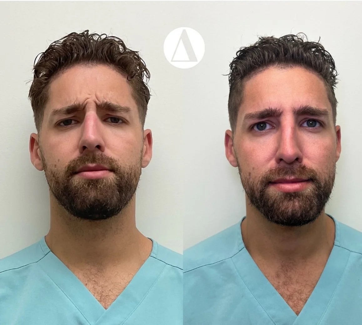 Frown Line Botox
