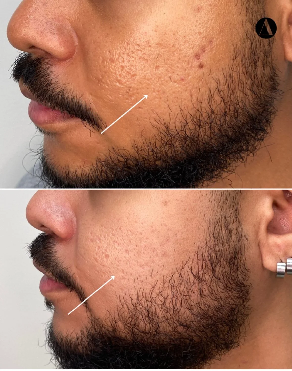 Dermapen4 DP4 Microneedling Acne and Acne Scars Before After results