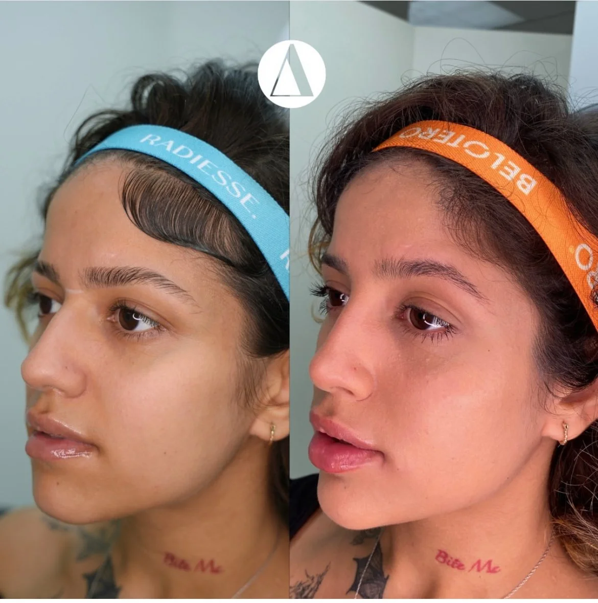 Full Face Balancing with Filler