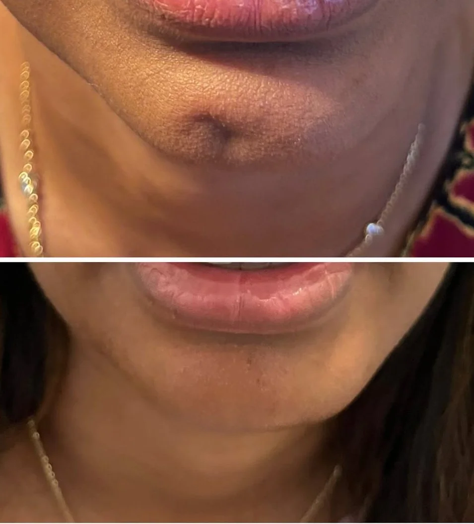 Chin Filler Deformity Correction
