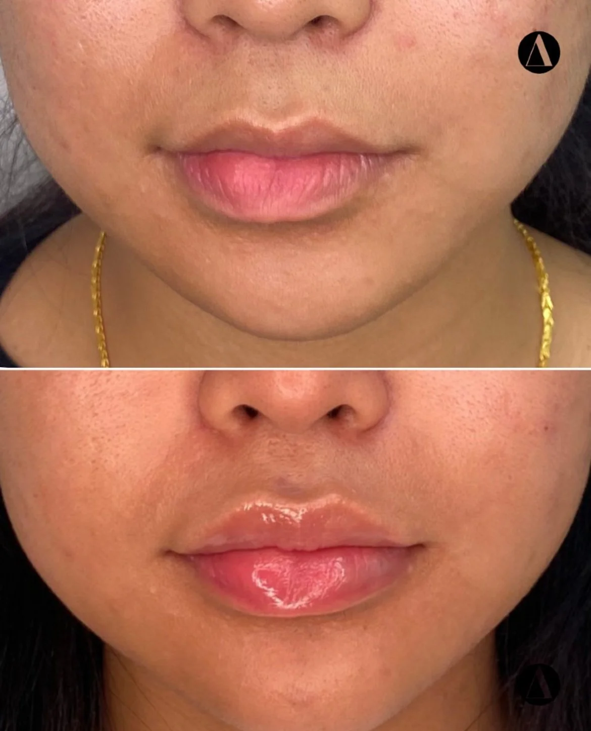 Lip filler full syringe before and after