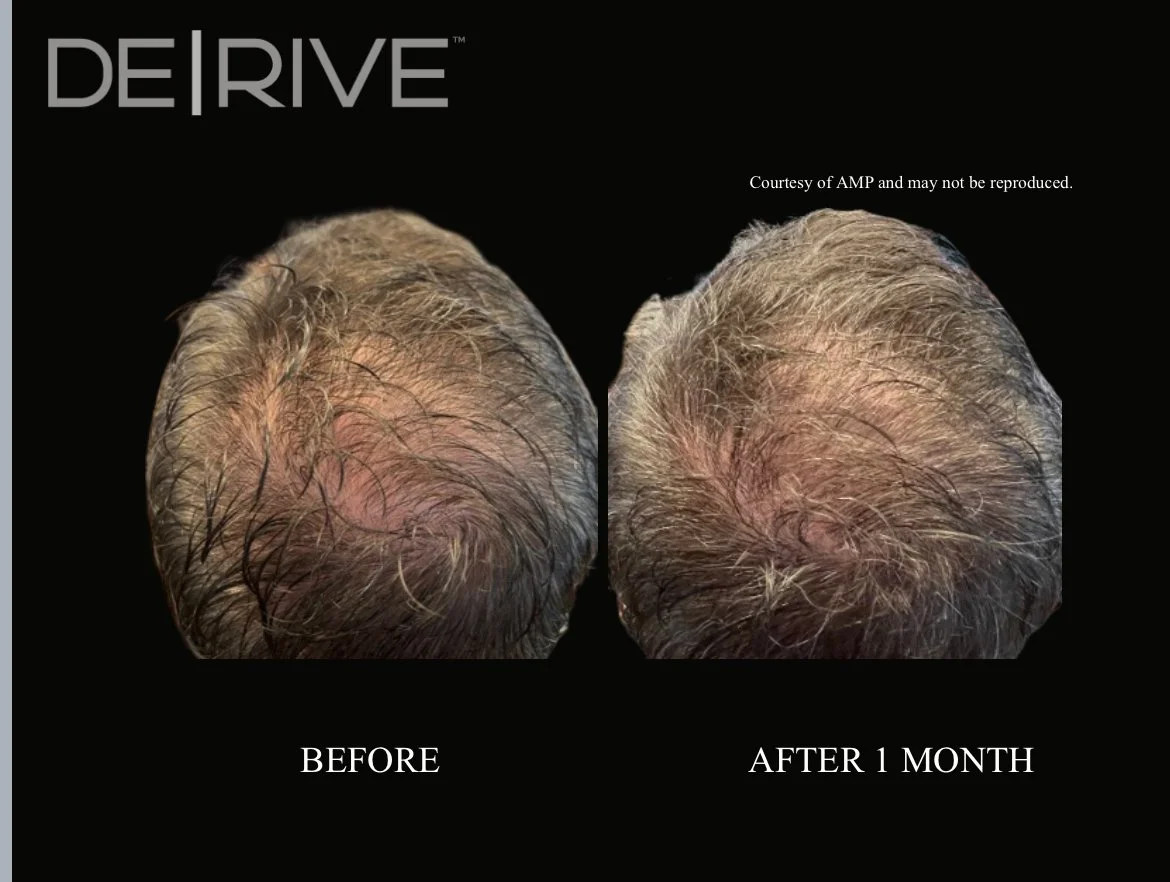 DE│RIVE BEFORE and AFTER HAIR LOSS GROWTH