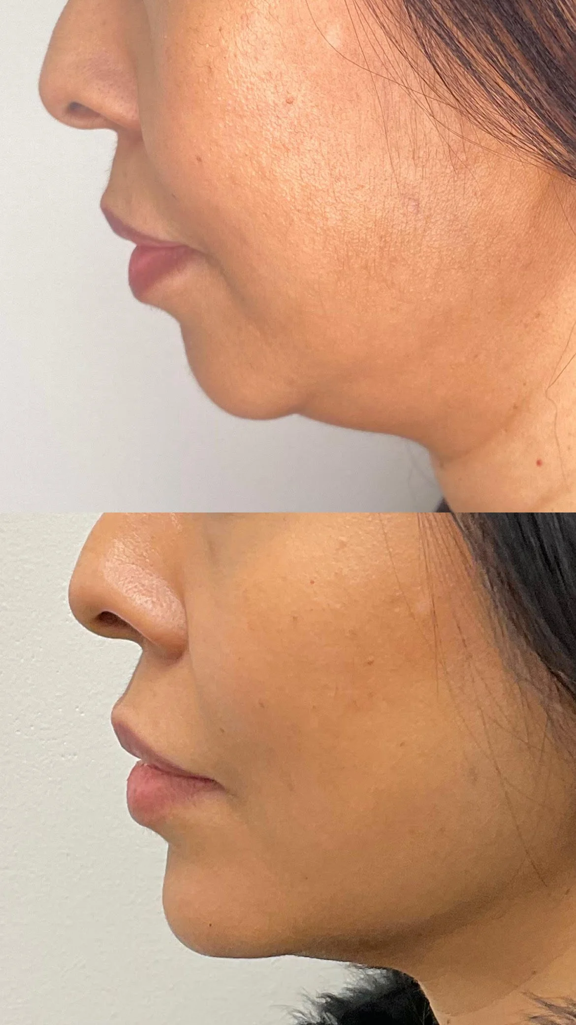 Chin Filler