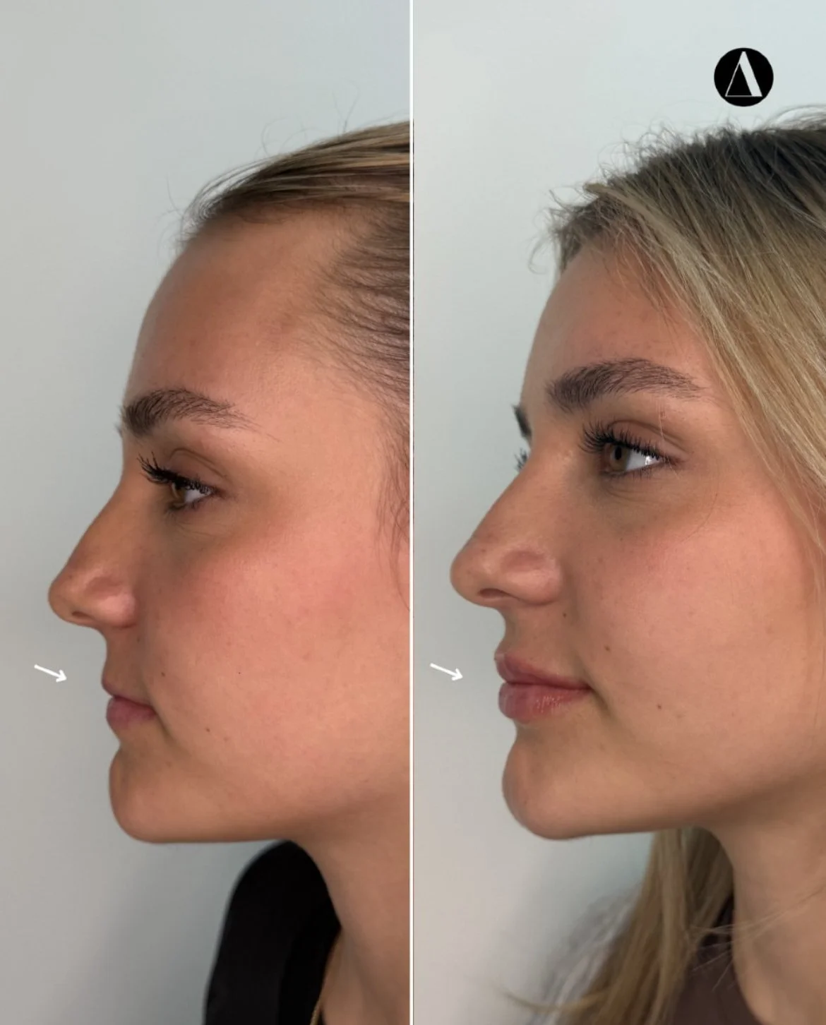 Subtle lip filler and lip hydration treatment