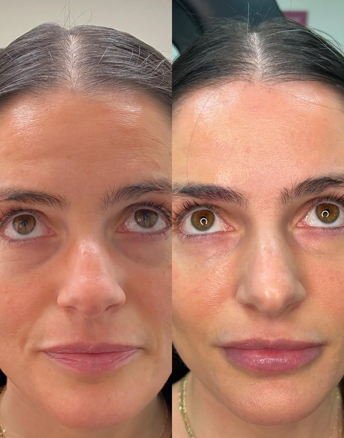 Tear Trough and Lips Before/After dermal filler results