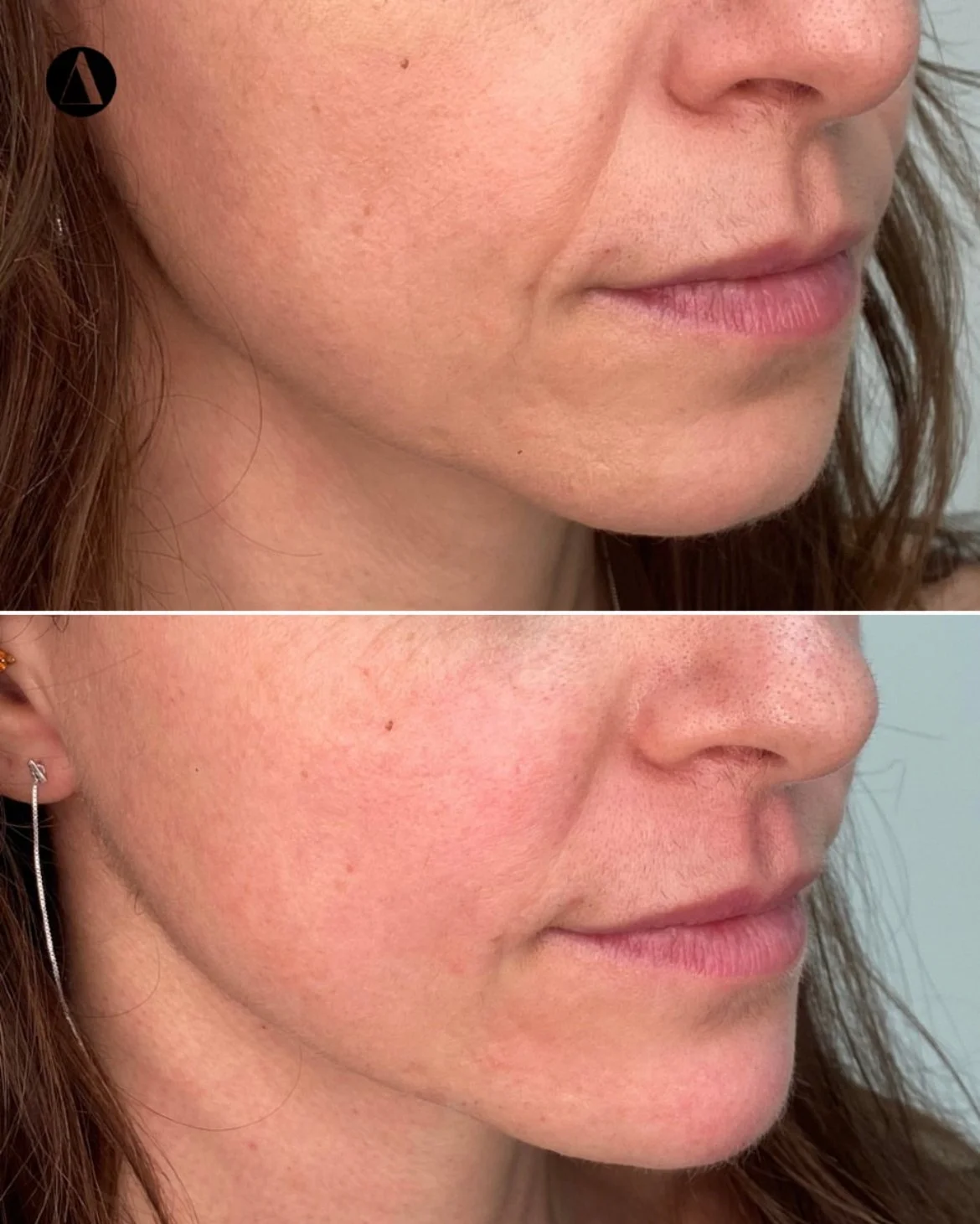 Radiesse before after results