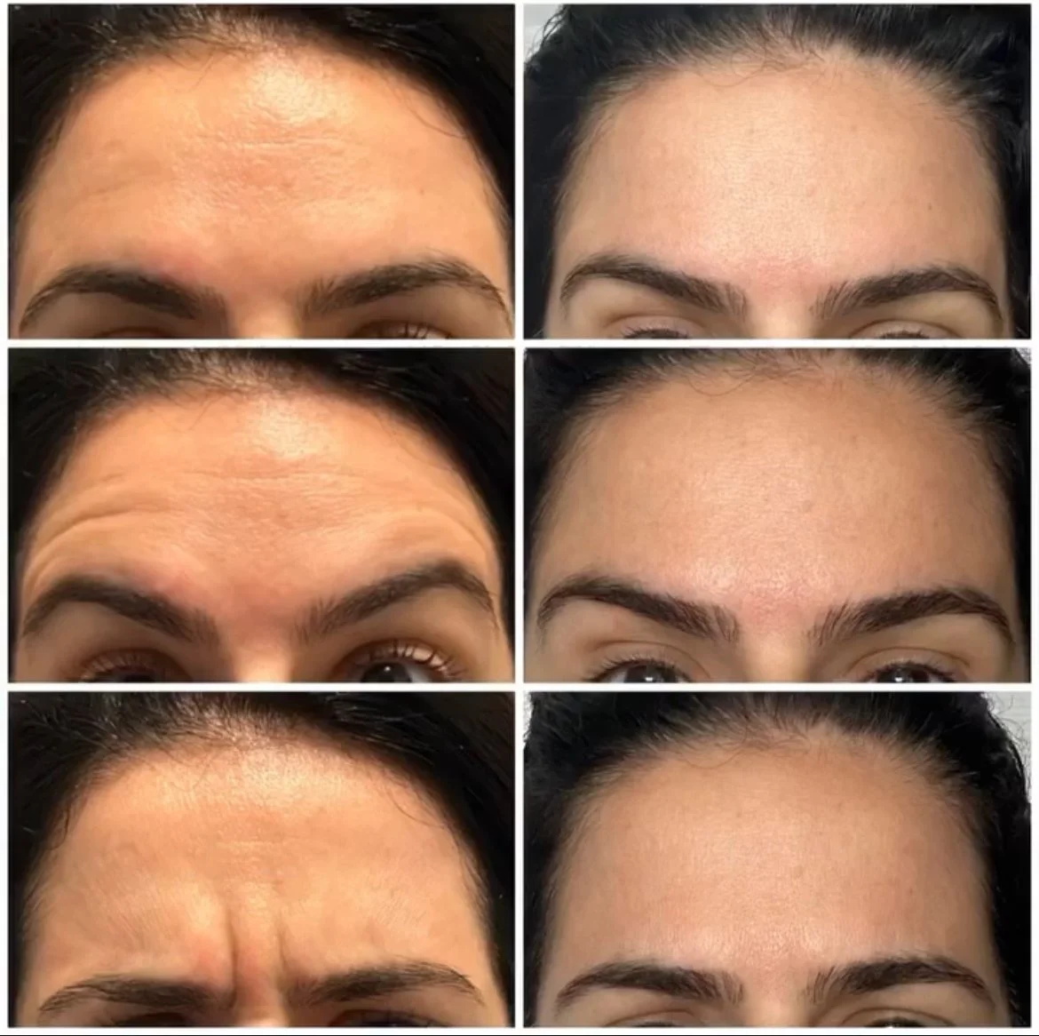Upper Face Botox