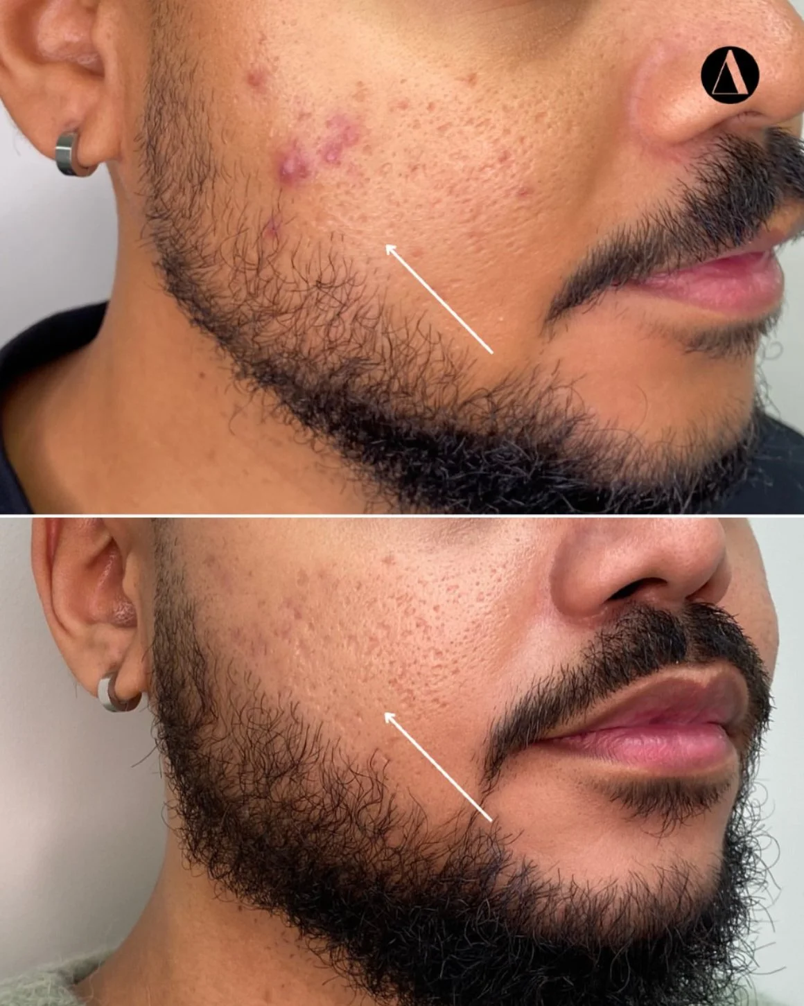 Acne and Scarring revision Aerolase and Microneedling