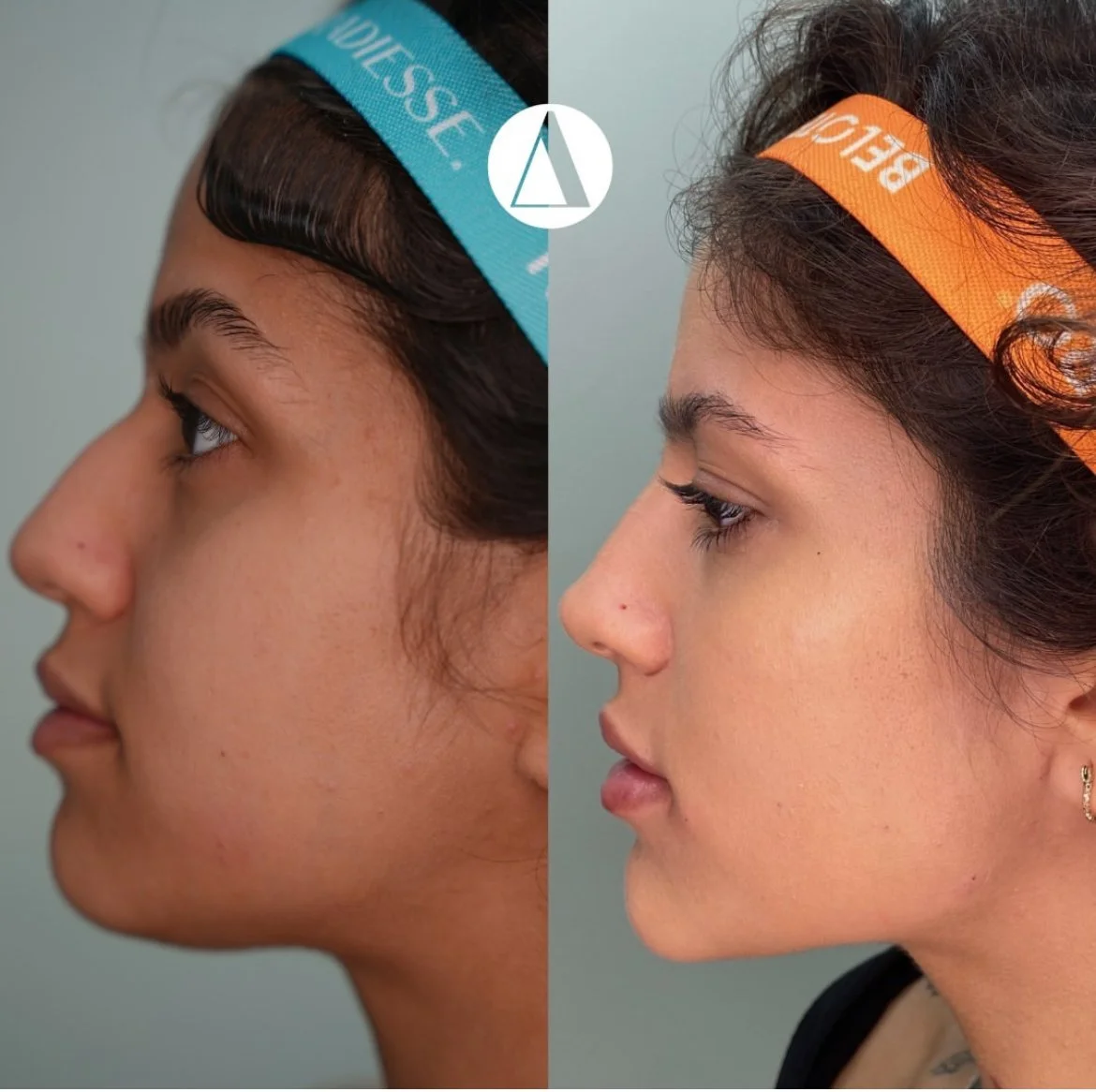 Full Face Balancing with Filler