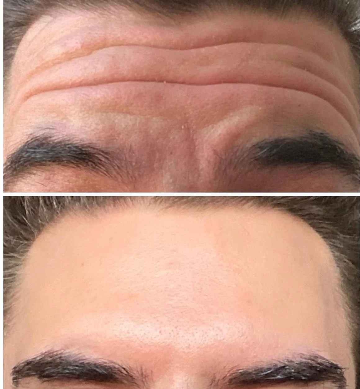 Forehead Wrinkle Botox