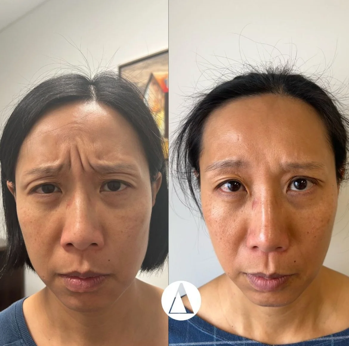 Frown Line Botox