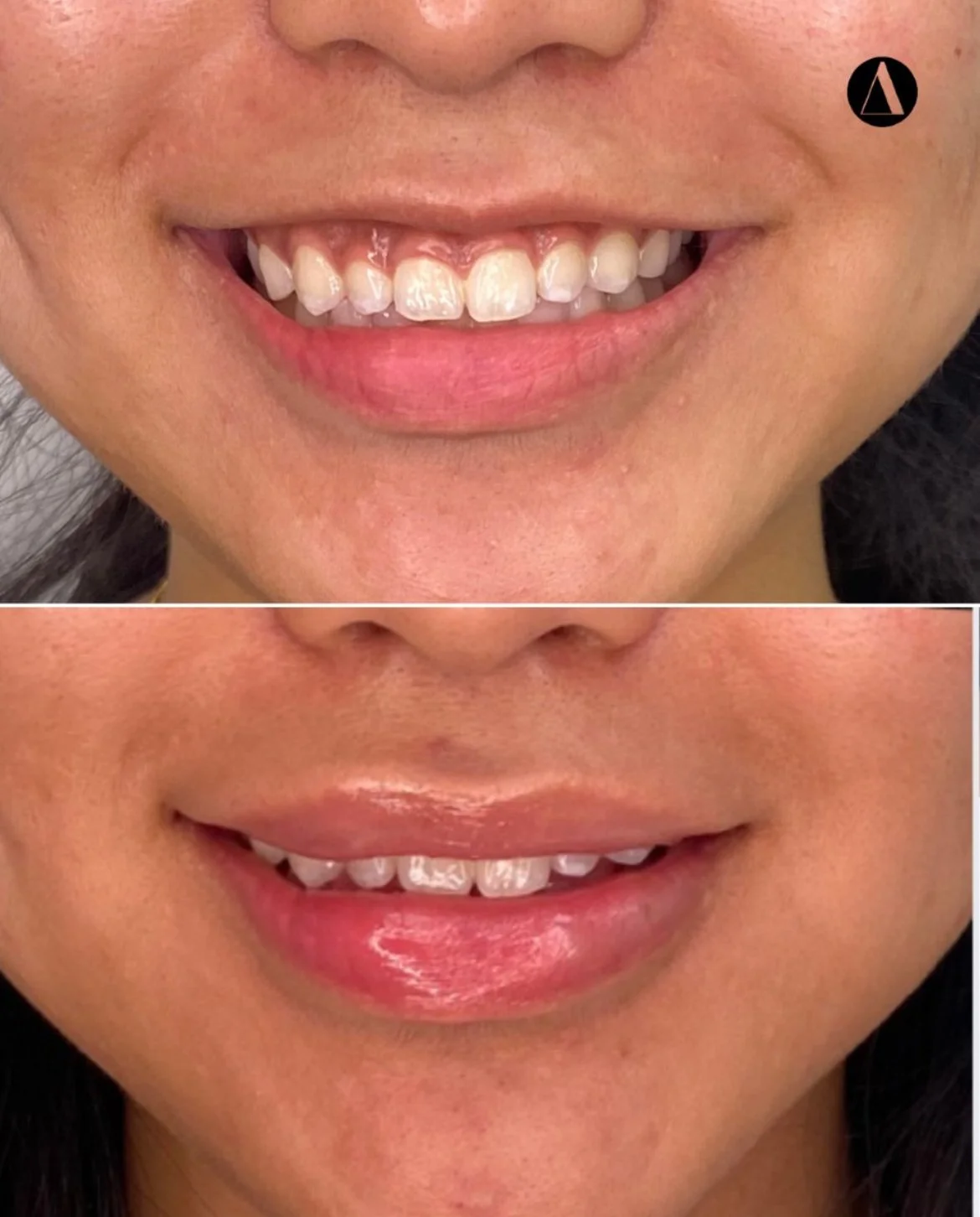 Lip Flip Botox