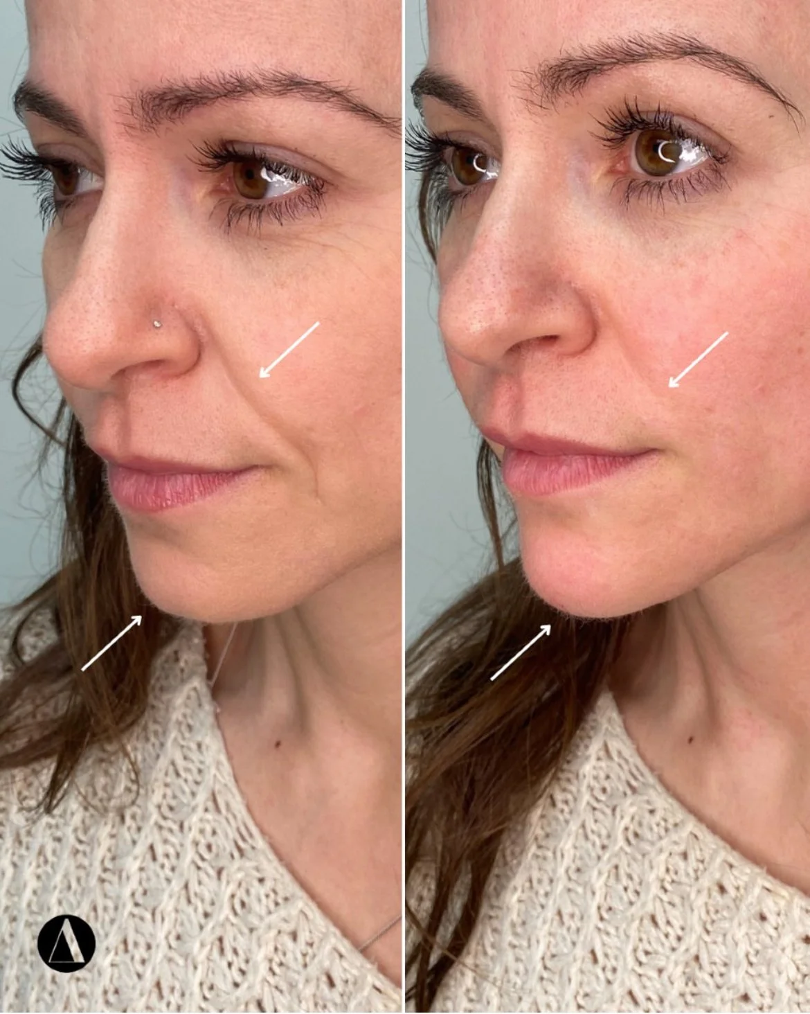 Nasolabial folds and accordion lines before after results
