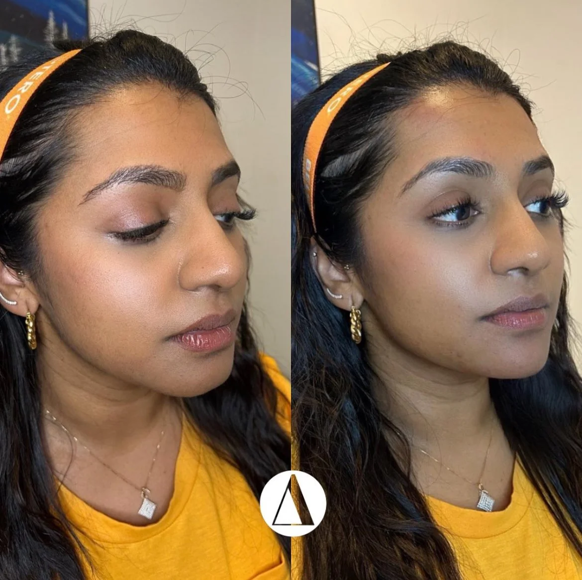 Dermal Filler Chin Before After
