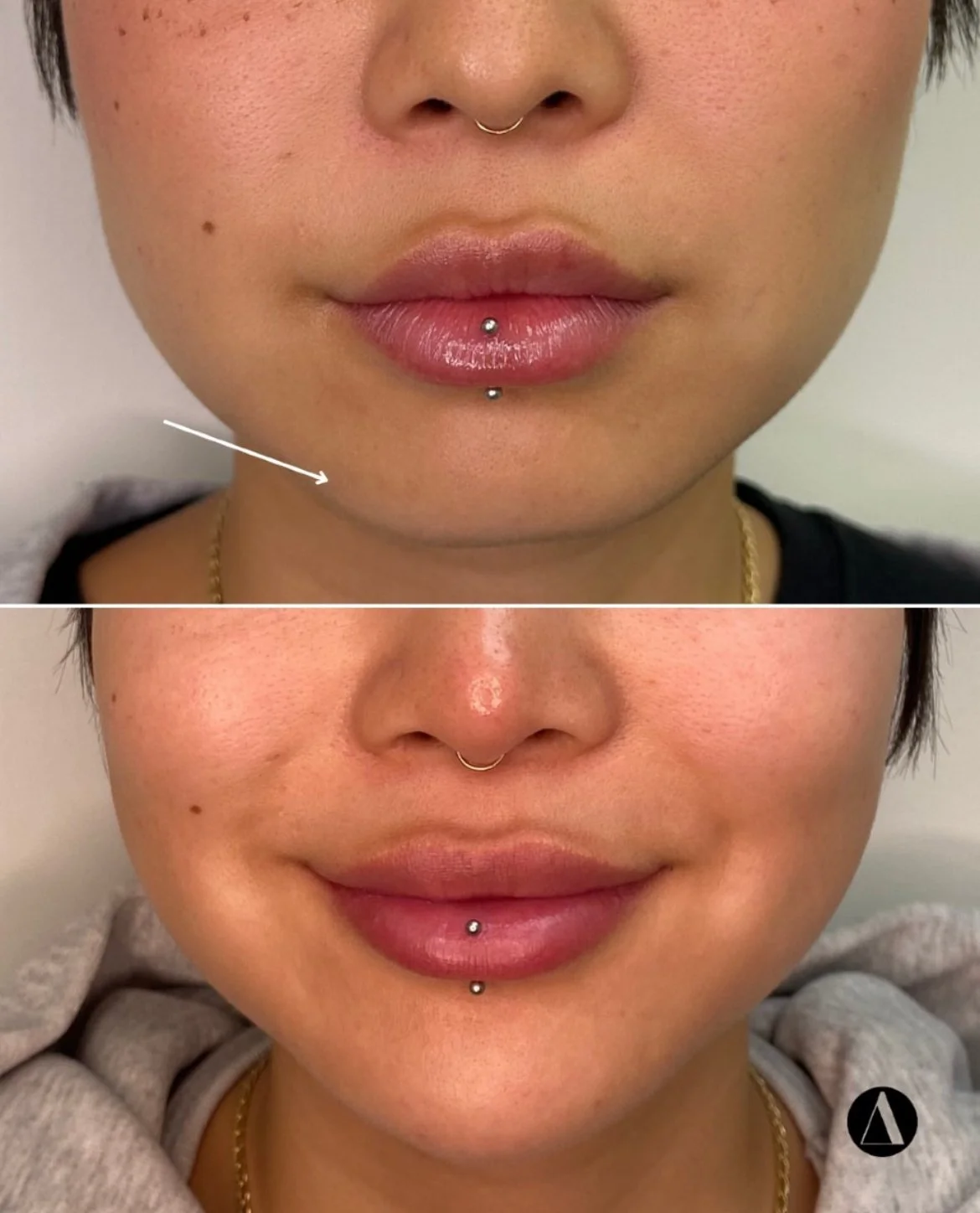 Chin Filler