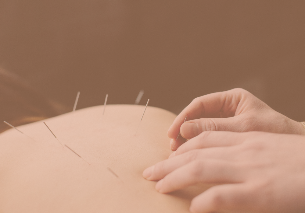 Community Acupuncture