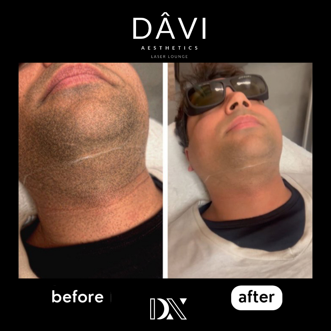 before after AD  - 4.png