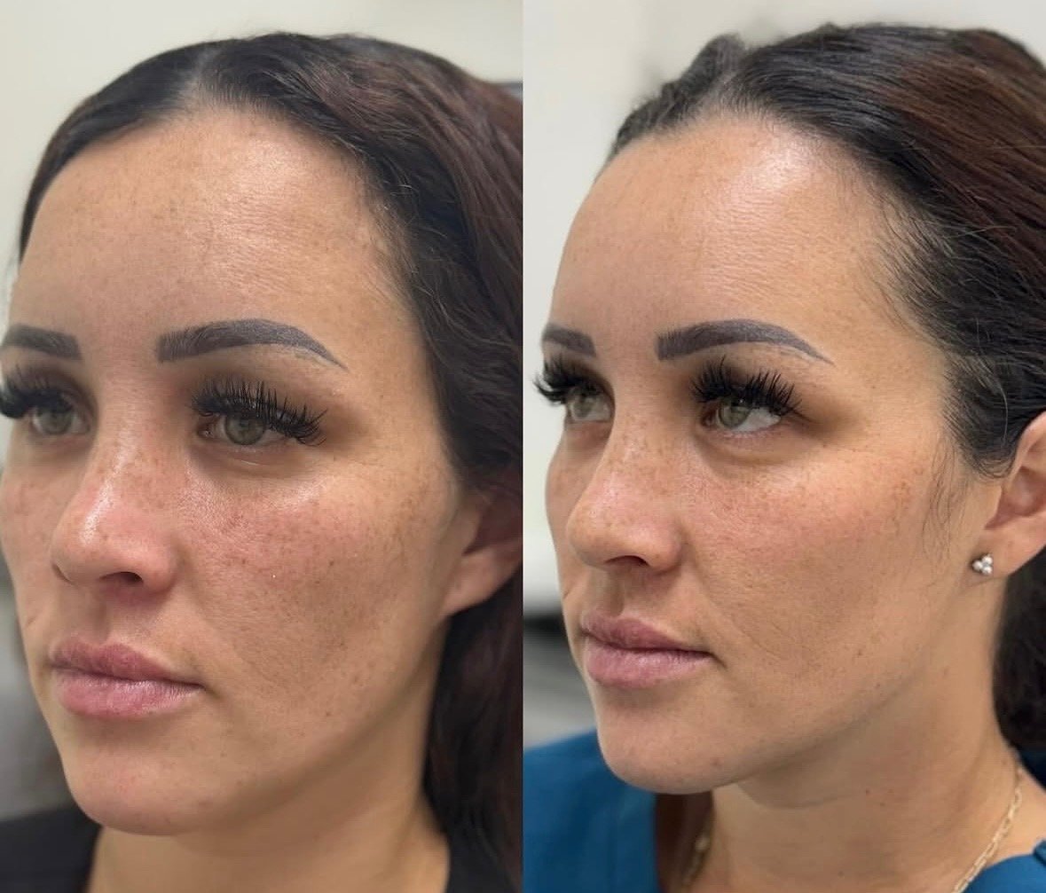 What You Need to Know About IPL Facials